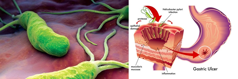 Helicobacter pylori hinchazon abdominal